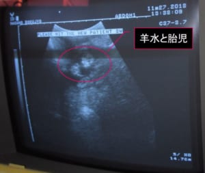 羊水と胎児の超音波画像